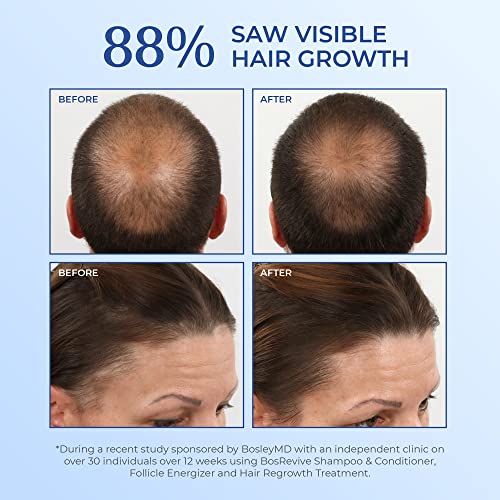Before and after photos of thinning crown and hairline from a BosleyMD study